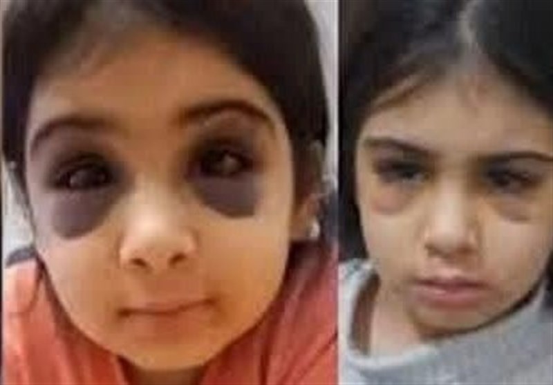 ضرب و شتم ‌«آنیلا» 9 ساله سنندجی با گوشت‌کوب!